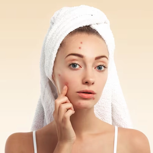 Acne Treatment