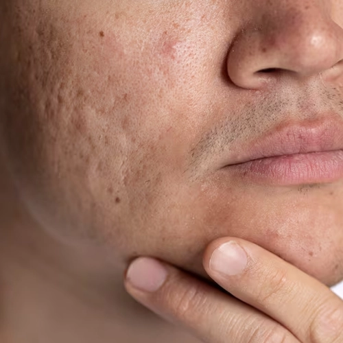 Acne Scar