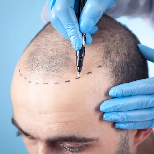 Hair Transplant Results