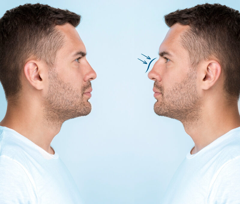HIFU skin tightening for men Delhi