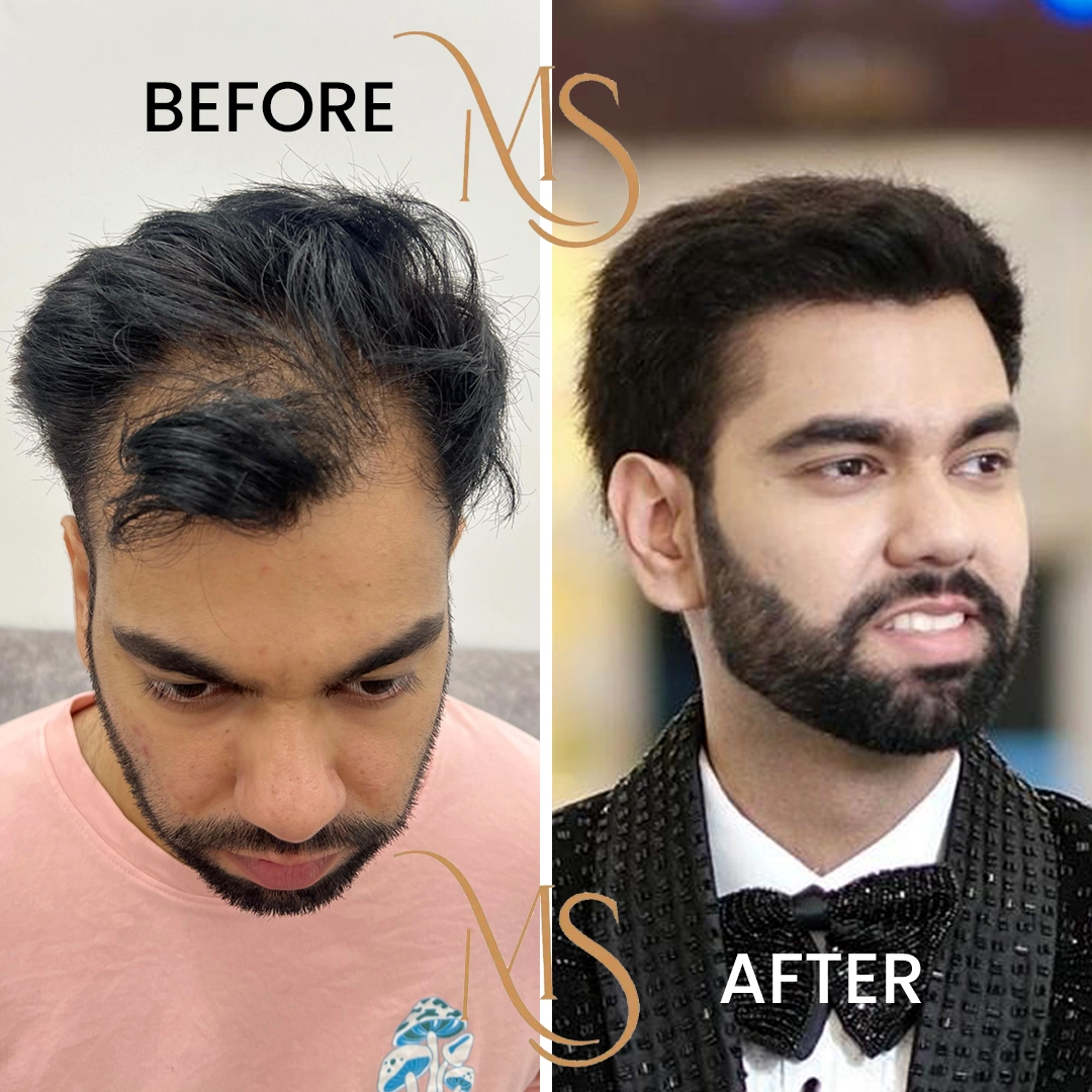 Hair Transplant Specialist Delhi